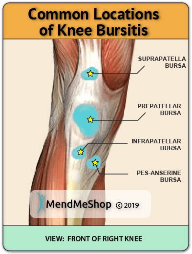 knee near sausalito|Knee bursitis .